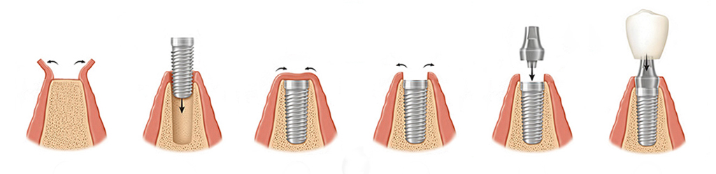 Имплантация зубов